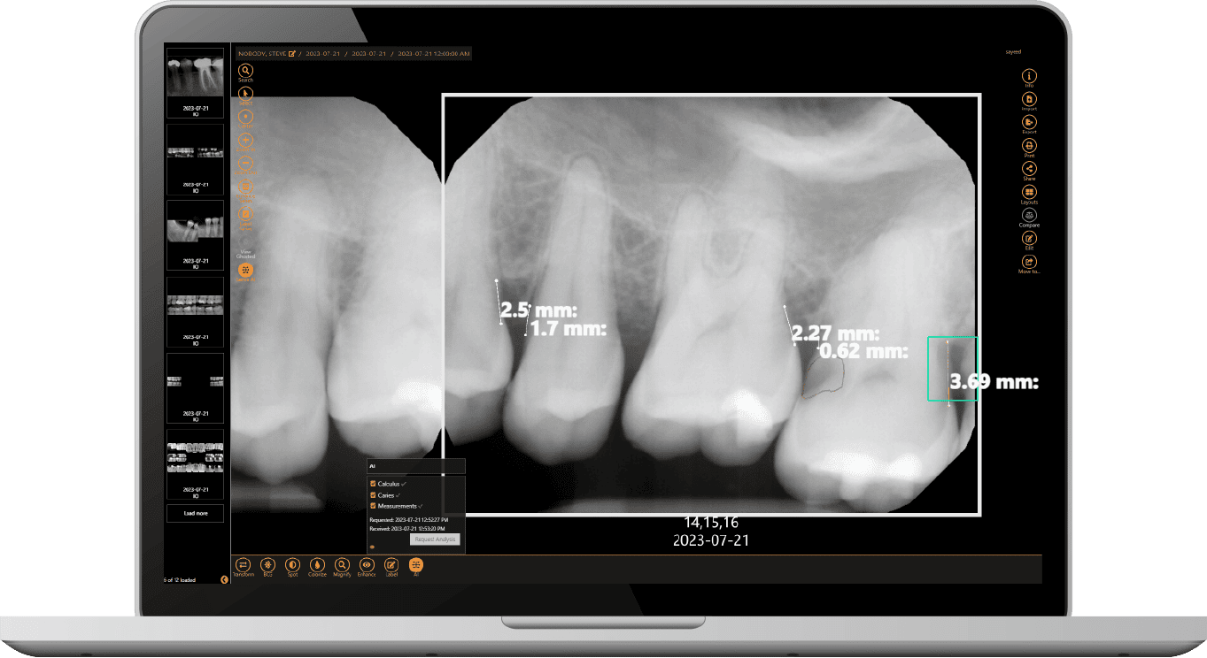 Laptop showing Apteryx AI utilized for imaging