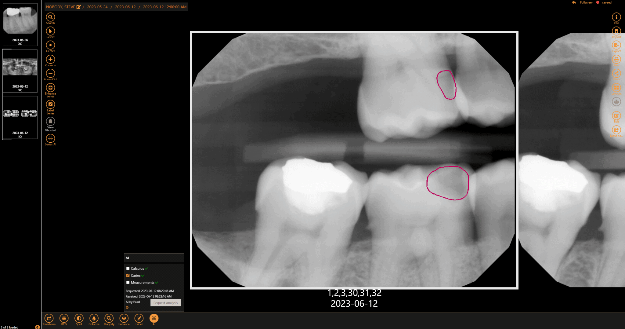 Dental Imaging AI Now Available From Planet DDS Dental Imaging AI Now Available From Planet DDS